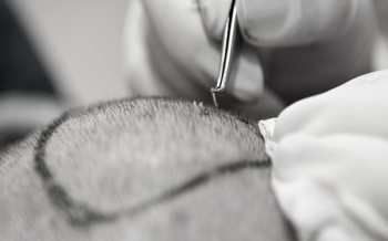 Saç Ekimi Nedir ve Nasıl Yapılır ?